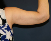 Feel Beautiful - Arm Reduction 210 - After Photo